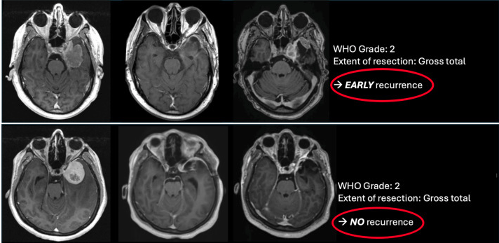 MRI examples from the 2026 meningioma review, showing recurrence and no recurrence
